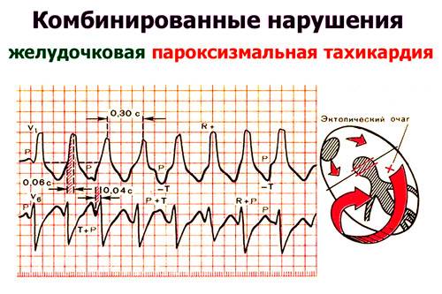 Внезапная смерть от желудочковой тахикардии
