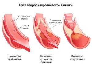 Атеросклероз аорты