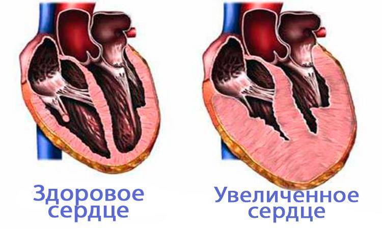 Увеличенное сердце
