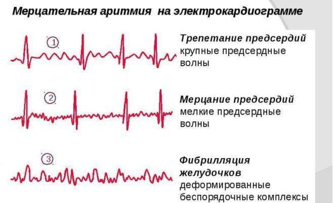 Аритмия