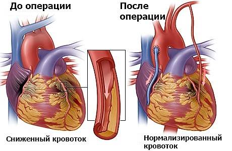 Аортокоронарное шунтирование - до и после