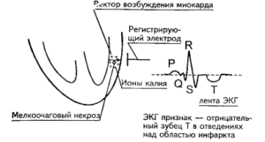 интрамуральный инфаркт миокарда