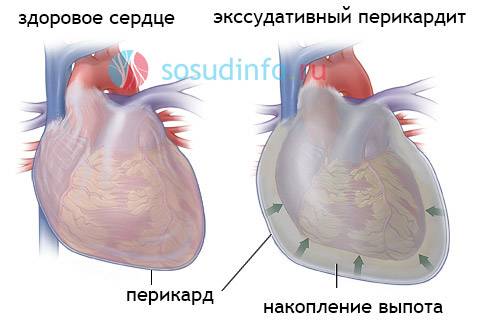 экссудативный (выпотной) перикардит