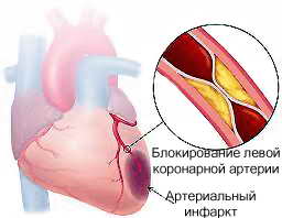 Инфаркт миокарда