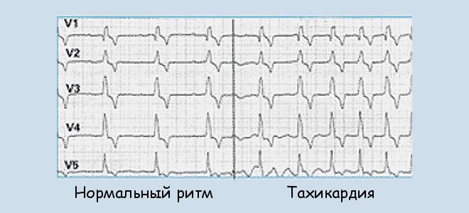 Синусовая аритмия лечение