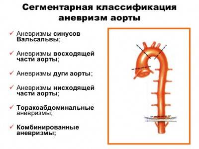 Классификация аневризм аорты