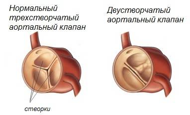 причины аортальной недостаточности