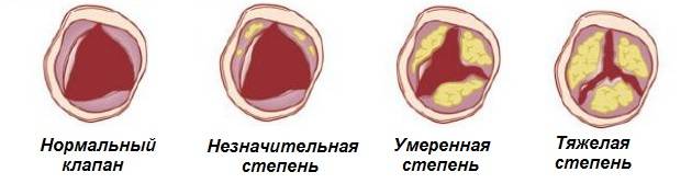 проявление заболевания