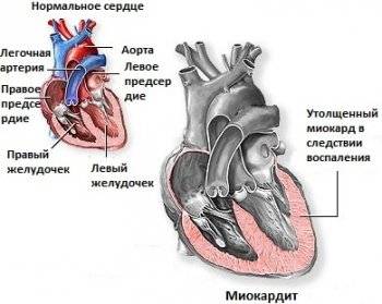 Симптомы миокардита