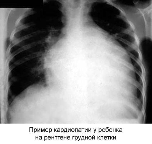 рентген грудной клетки ребенка с функциональной кардиопатией