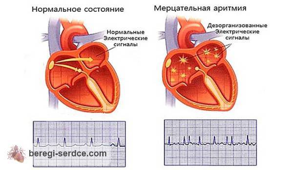 Мерцательная аритмия: симптомы и лечение