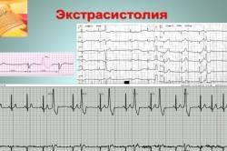 Электрокардиограмма при экстрасистолии