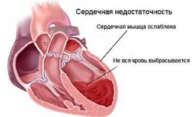 сердечная недостаточность сердечная недостаточность