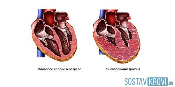 Здоровое сердце и при миокардите Миокардит