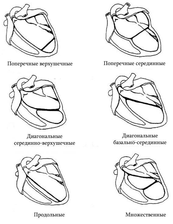 схематичное изображение вариантов дополнительных хорд в сердце