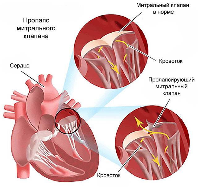 пролапс митрального клапан