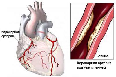 Коронарный атеросклероз