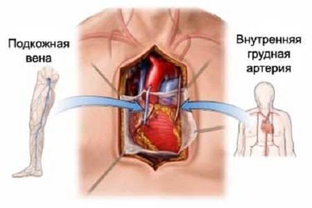 шунтирование_сосудов_сердца