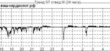 Тренд при депрессии сегмента ST Тренд при депрессии сегмента ST