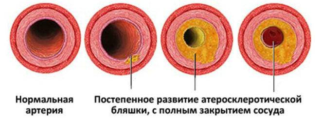 Ишемия