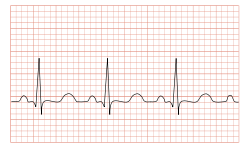 Tachycardia ECG paper.svg