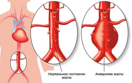 Что такое аневризма аорты