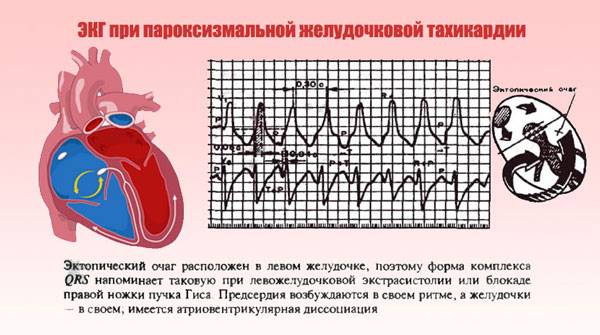 Пароксизмальная желудочковая тахикардия на ЭКГ