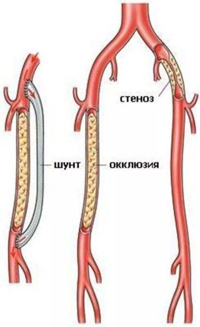 Как образовывается окклюзия вен