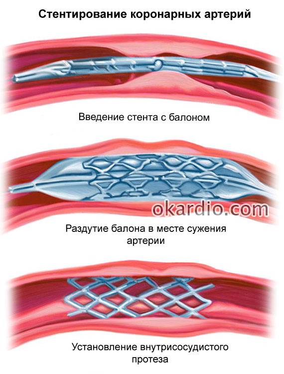 стентирование сосудов