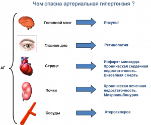 Особенности гипертонии Гипертония 3 стадии