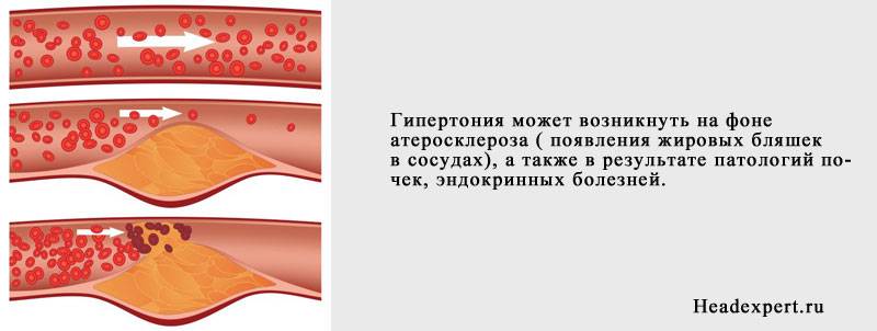 Высокое давление (гипертония) может стать последствием атеросклероза Высокое давление (гипертония) может стать последствием атеросклероза