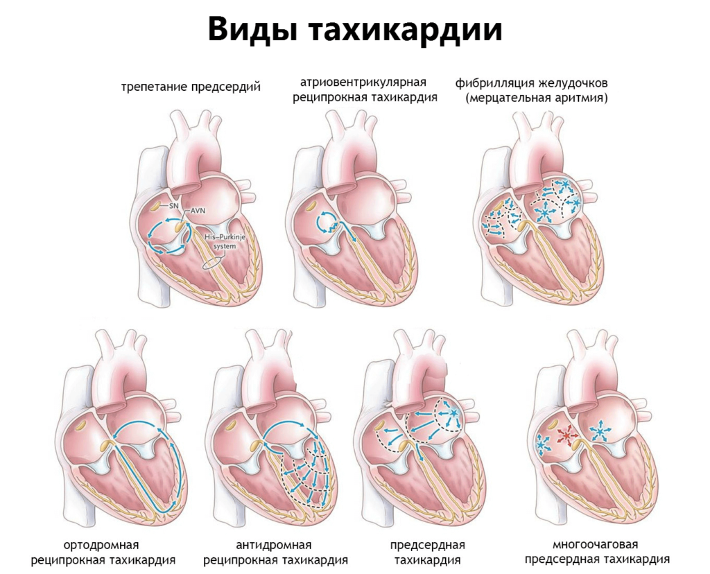 Тахикардия что это такое