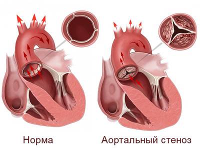 аортальный стеноз аортальный стеноз