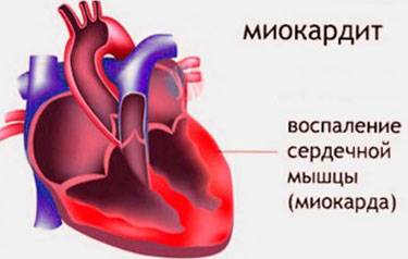 Миокардит острый
