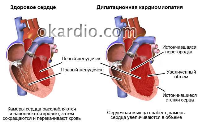 дилатационная кардиомиопатия