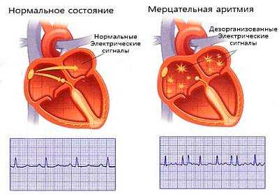 Аритмия сердца мерцательная