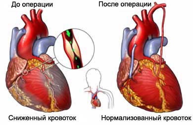 Аортокоронарное шунтирование Аортокоронарное шунтирование