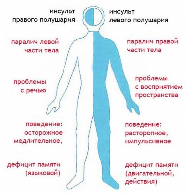 Разница между последствиями инсультов у человека