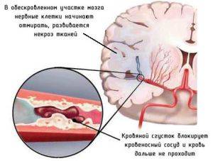 как происходит инсульт