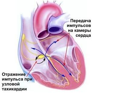 Синусовая тахикардия