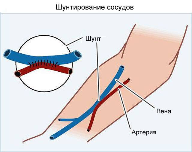 шунтирование сосудов