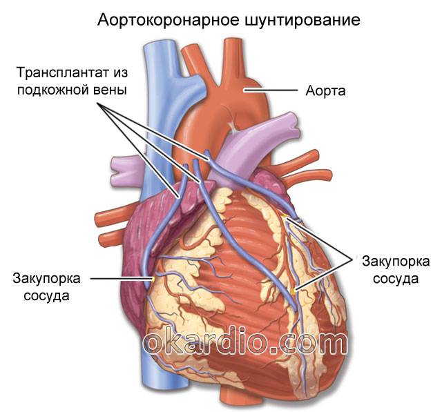 аортокоронарное шунтирование