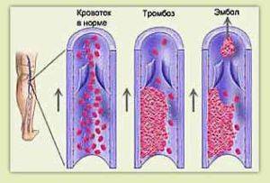образование тромба