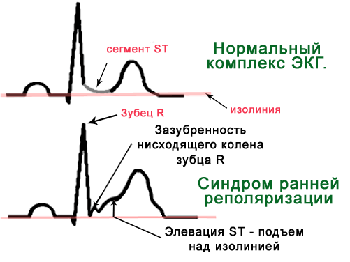 ЭКГ в норме и при синдроме ранней реполяризации Диагностика