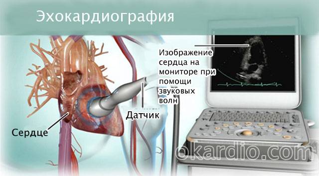 эхокардиография