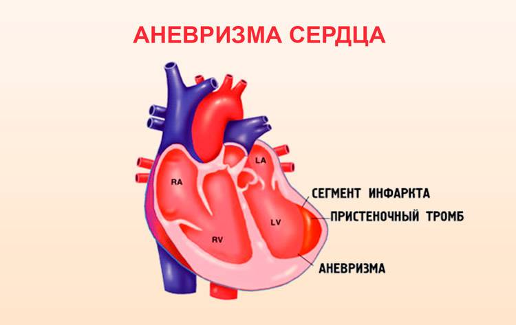 Аневризма
