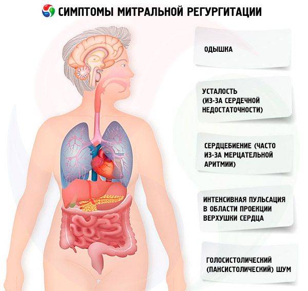 Регургитация митральная