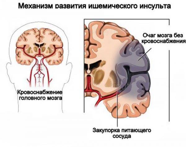 Механизм развития ишемического инсульта