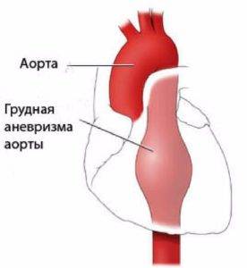 причины острой боли за грудиной