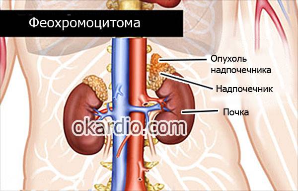 феохромоцитома